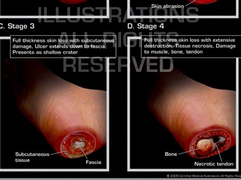 Left heel pressure ulcer icd 10 421